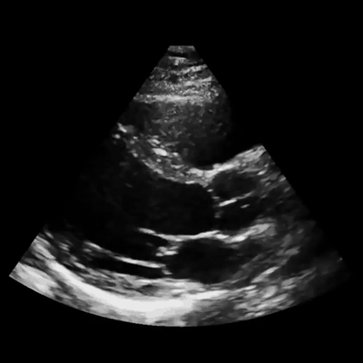 Live echocardiogram loop analyzed by the computer vision model